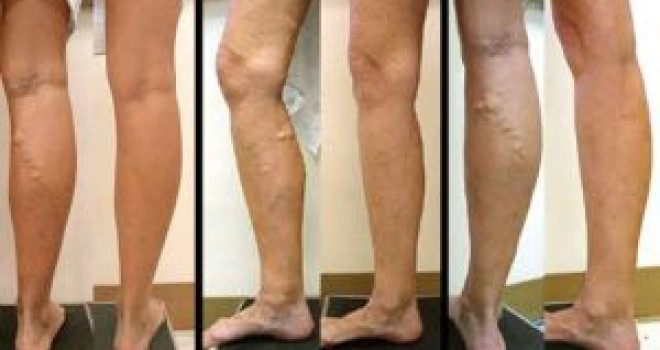 GRÁVIDAS CORREM MAIS RISCO DE TER VARIZES GRÁVIDAS CORREM MAIS RISCO DE TER VARIZES