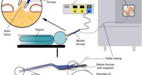 BISTURI INTELIGENTE FAZ BIÓPSIA DE CÂNCER DURANTE CIRURGIA BISTURI INTELIGENTE FAZ BIÓPSIA DE CÂNCER DURANTE CIRURGIA