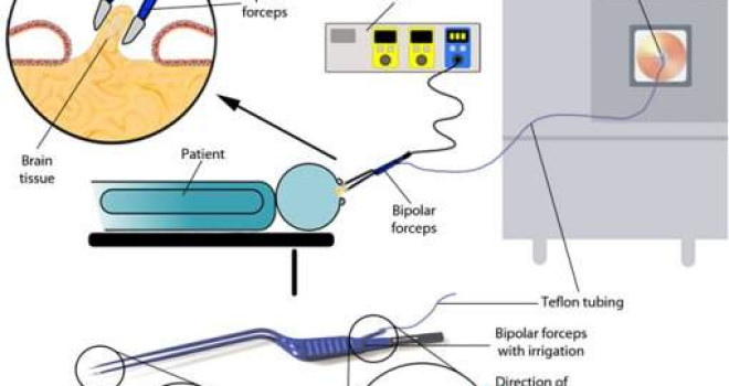 BISTURI INTELIGENTE FAZ BIÓPSIA DE CÂNCER DURANTE CIRURGIA BISTURI INTELIGENTE FAZ BIÓPSIA DE CÂNCER DURANTE CIRURGIA