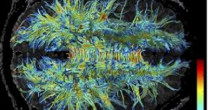 PARKINSON EVOLUI DE FORMA DIFERENTE NAS MULHERES E NOS HOMENS PARKINSON EVOLUI DE FORMA DIFERENTE NAS MULHERES E NOS HOMENS
